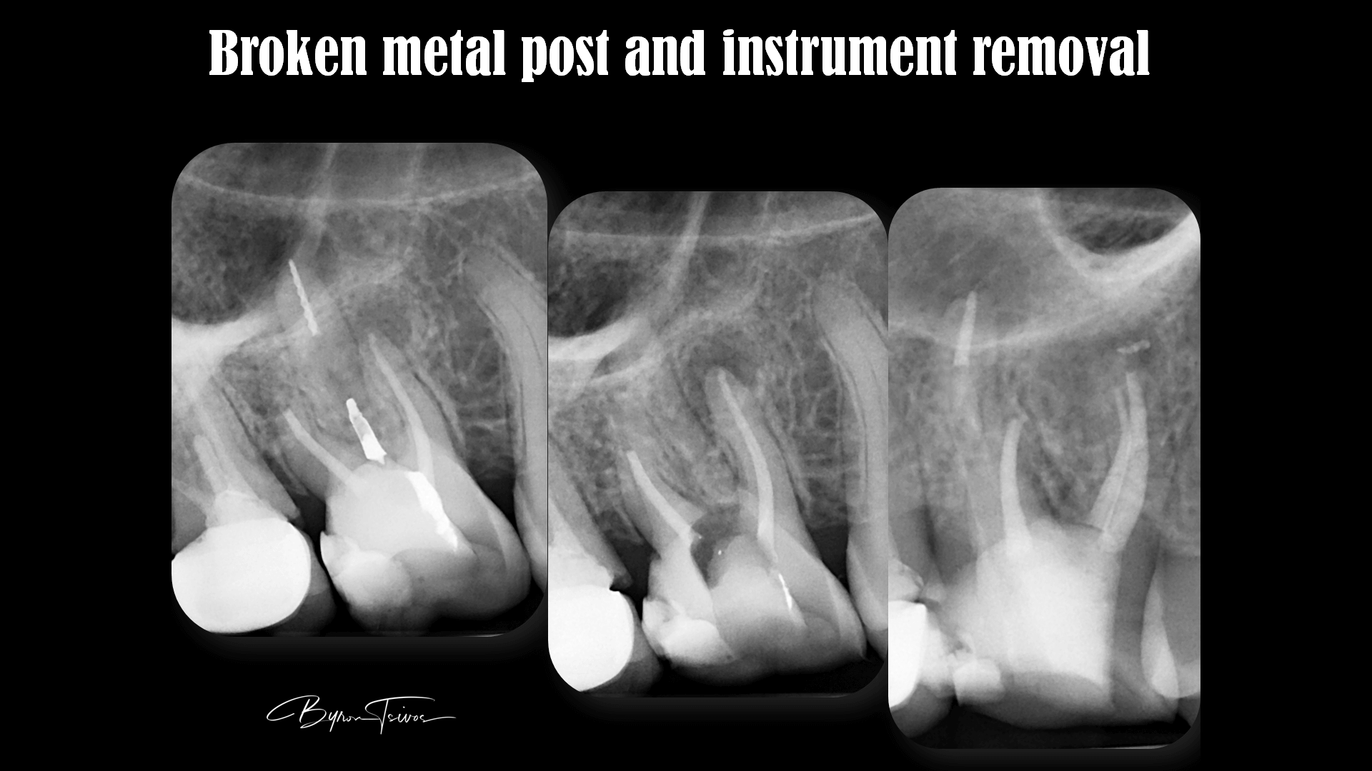 Broken Instrument Removal - Case 6